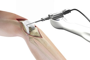 How Robotics is Changing Joint Replacement